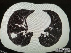 什么是肺梅毒？