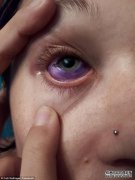 一名年轻的加拿大妇女因眼球发炎不足而无法打