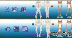 [腿矫正方法不直]腿矫正方法不直