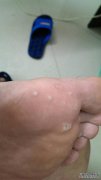 大拇指根部的疾病是什么？
