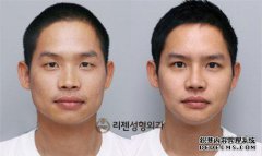 下巴手术会使我的脸更长吗？