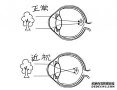 什么是单纯性远视散光，再生远视散光？