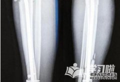 中年小腿骨折方法