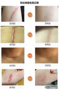 如何保养好粉刺