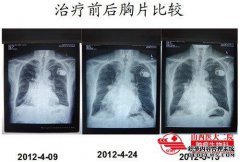 哪种类型的药物适合于较大的肺泡？