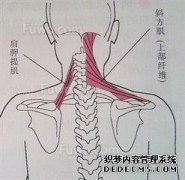 先天性颈部倾斜
