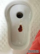 严重的乳汁凝胶如何治疗严重的宫颈糜烂