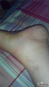 [踝部肿胀如何立即减轻肿胀和疼痛？